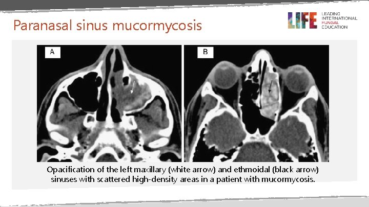 Paranasal sinus mucormycosis Opacification of the left maxillary (white arrow) and ethmoidal (black arrow)