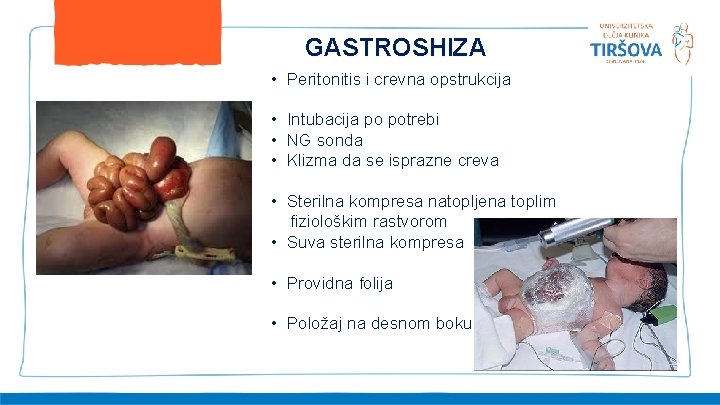 GASTROSHIZA • Peritonitis i crevna opstrukcija • Intubacija po potrebi • NG sonda •