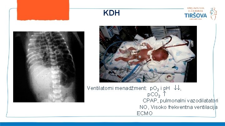 KDH Ventilatorni menadžment: p. O 2 i p. H , p. CO 2 CPAP,