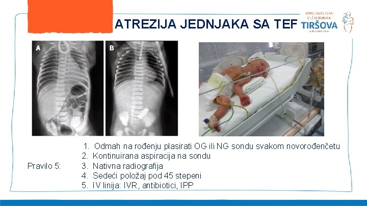 ATREZIJA JEDNJAKA SA TEF Pravilo 5: 1. 2. 3. 4. 5. Odmah na rođenju