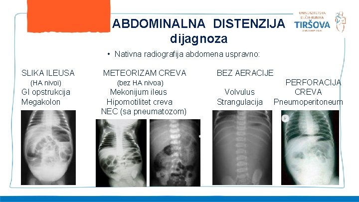 ABDOMINALNA DISTENZIJA dijagnoza • Nativna radiografija abdomena uspravno: SLIKA ILEUSA (HA nivoi) GI opstrukcija
