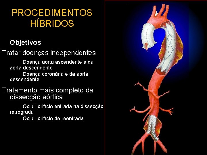 PROCEDIMENTOS HÍBRIDOS Objetivos Tratar doenças independentes Doença aorta ascendente e da aorta descendente Doença