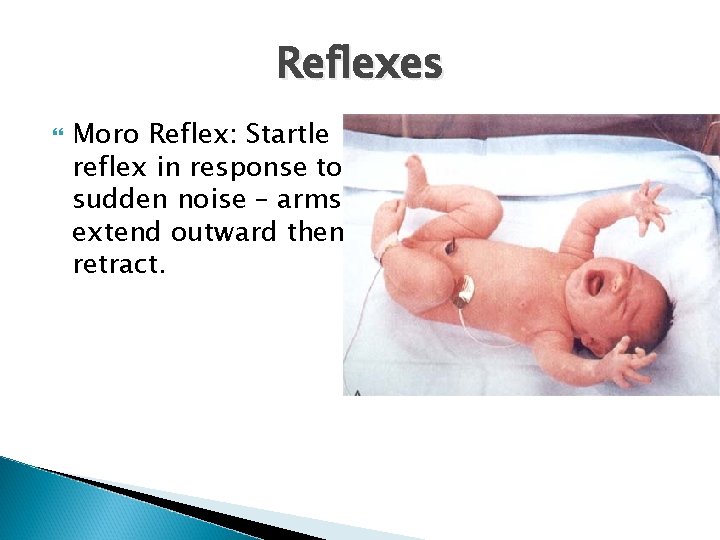 Reflexes Moro Reflex: Startle reflex in response to sudden noise – arms extend outward