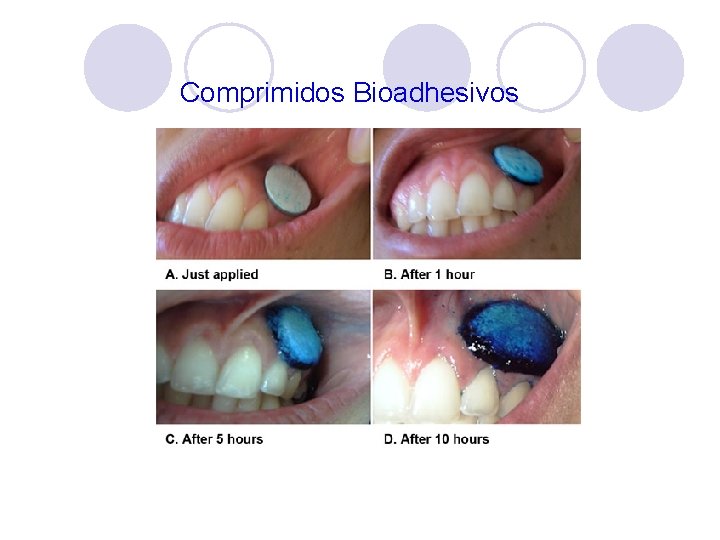 Comprimidos Bioadhesivos BEMA: disco mucoadhesivo bioerosionable Comprimidos Bioadhesivos BEMA: disco mucoadhesivo bioerosionable