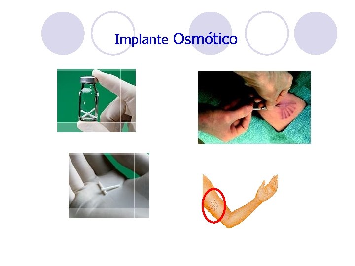Implante Osmótico Implante Osmótico