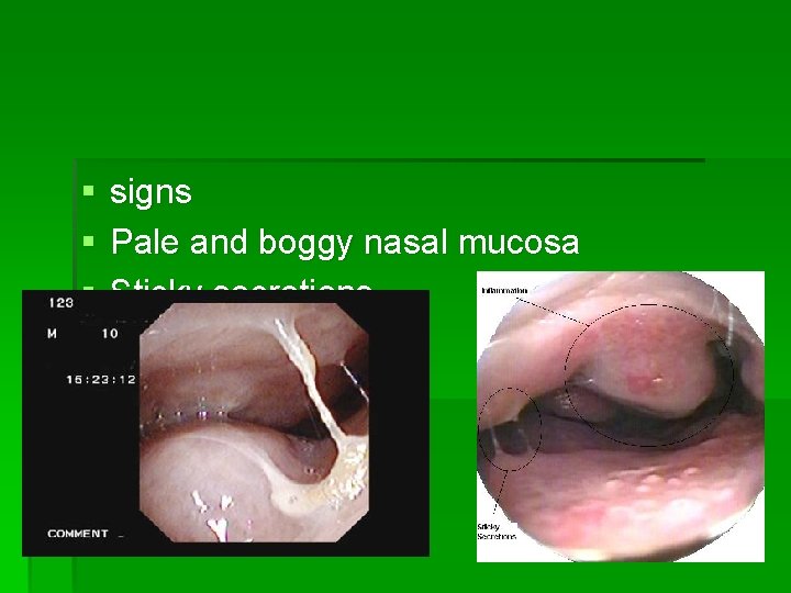 § § § signs Pale and boggy nasal mucosa Sticky secretions 