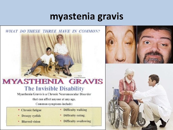 myastenia gravis myastenia gravis
