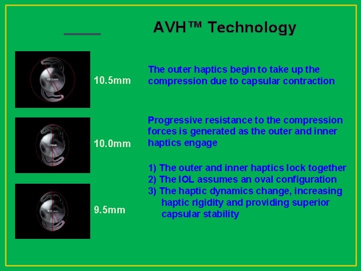 AVH™ Technology 10. 5 mm The outer haptics begin to take up the compression