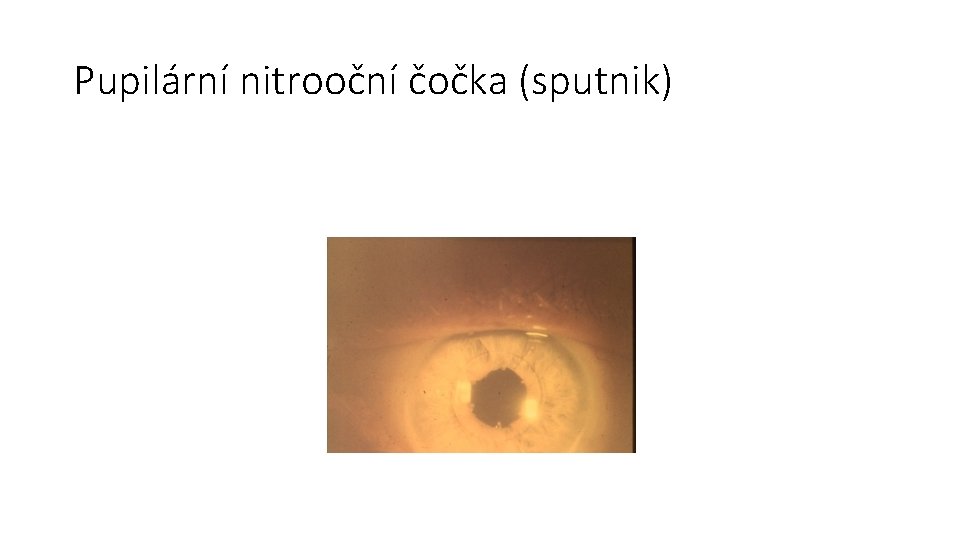 Pupilární nitrooční čočka (sputnik) 