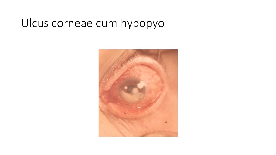 Ulcus corneae cum hypopyo 