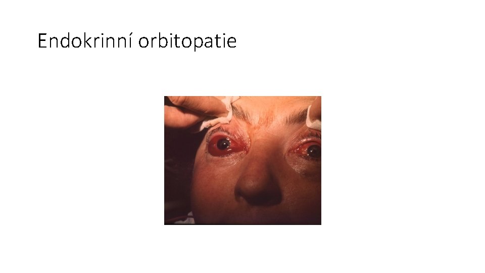 Endokrinní orbitopatie 