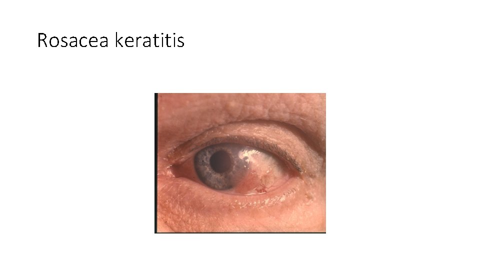 Rosacea keratitis 