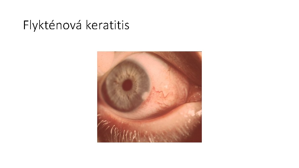 Flykténová keratitis 