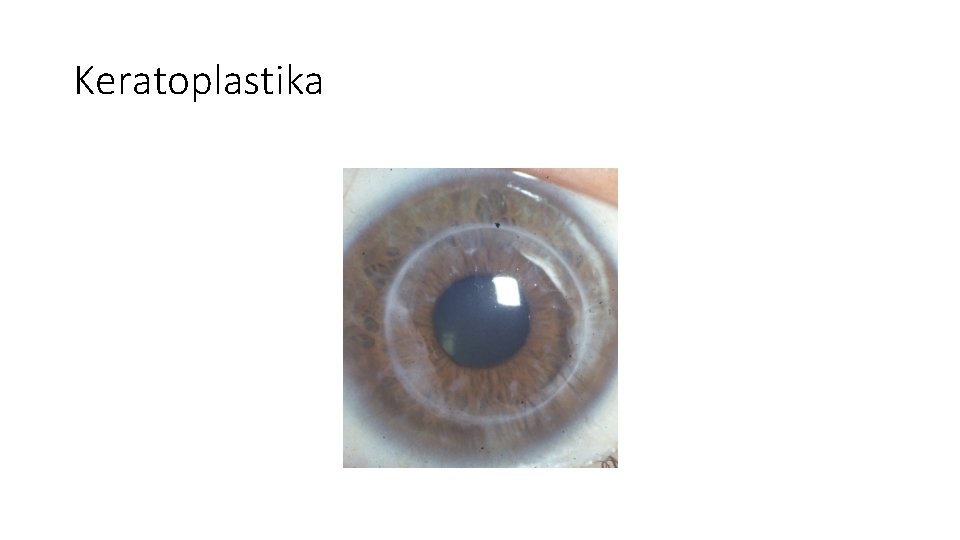 Keratoplastika 