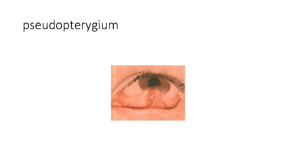 pseudopterygium 