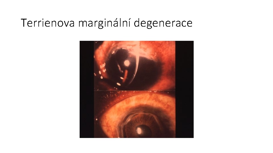 Terrienova marginální degenerace 