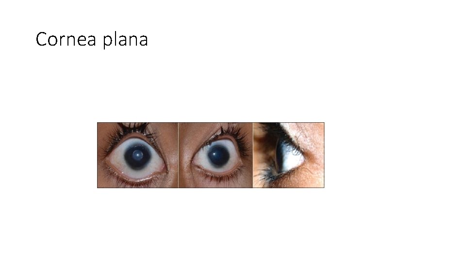 Cornea plana 