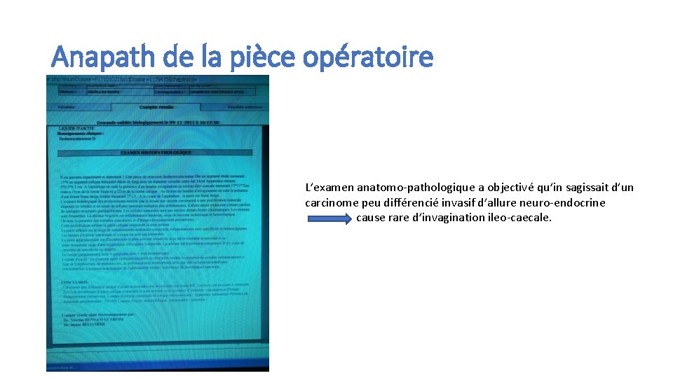 Anapath de la pièce opératoire L’examen anatomo-pathologique a objectivé qu’in sagissait d’un carcinome peu