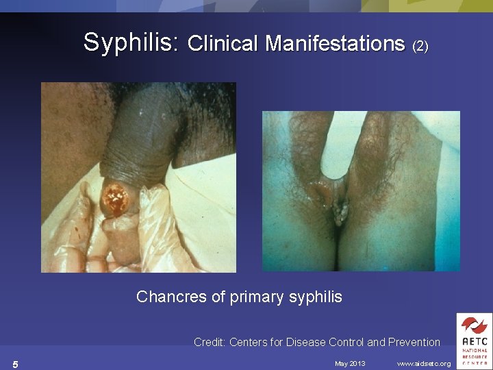 Syphilis: Clinical Manifestations (2) Chancres of primary syphilis Credit: Centers for Disease Control and