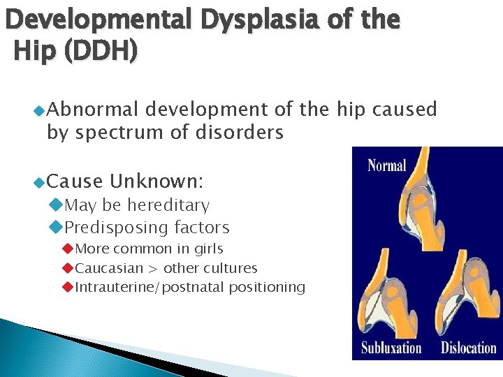 Developmental Dysplasia of the Hip (DDH) Abnormal development of the hip caused by spectrum