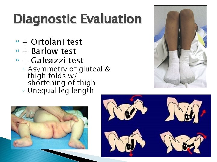 Diagnostic Evaluation + Ortolani test + Barlow test + Galeazzi test ◦ Asymmetry of