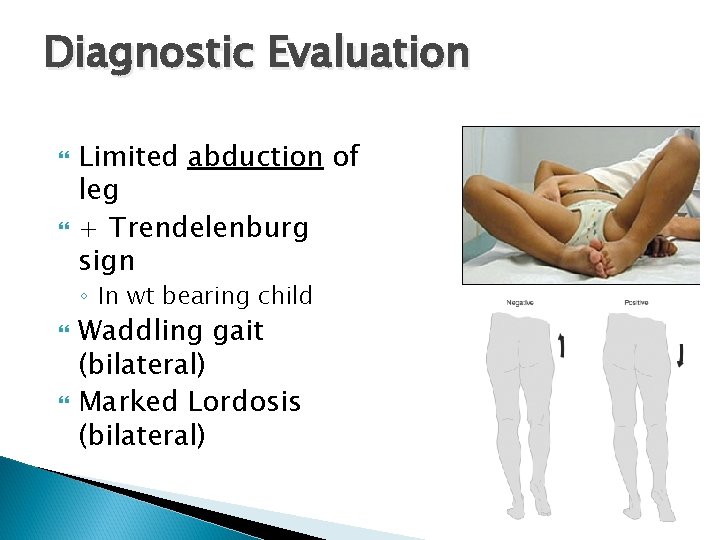 Diagnostic Evaluation Limited abduction of leg + Trendelenburg sign ◦ In wt bearing child