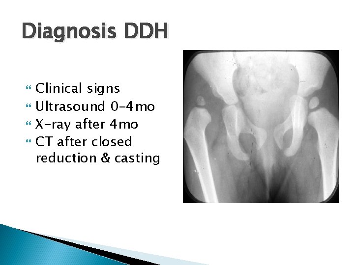 Diagnosis DDH Clinical signs Ultrasound 0 -4 mo X-ray after 4 mo CT after