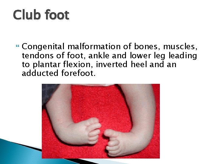 Club foot Congenital malformation of bones, muscles, tendons of foot, ankle and lower leg