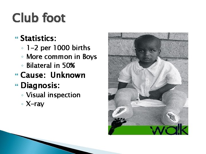 Club foot Statistics: ◦ 1 -2 per 1000 births ◦ More common in Boys