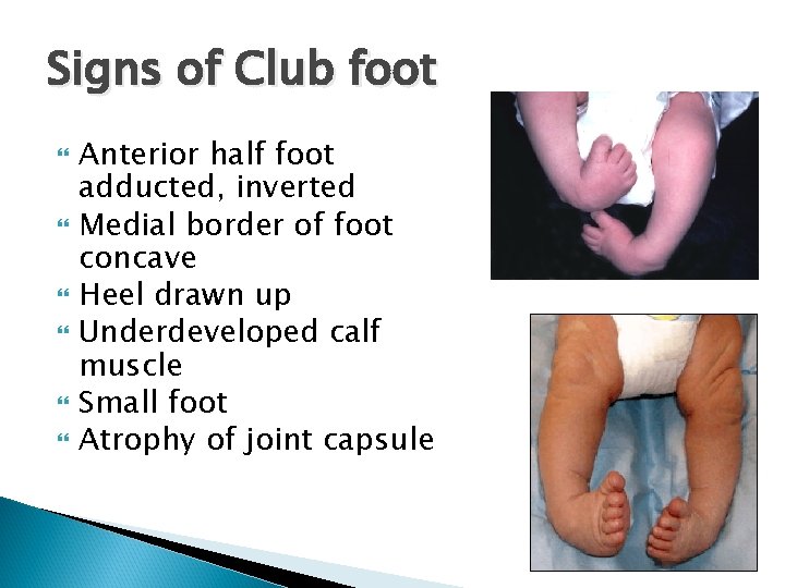 Signs of Club foot Anterior half foot adducted, inverted Medial border of foot concave