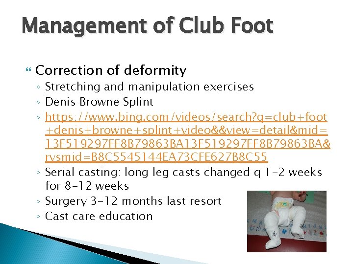 Management of Club Foot Correction of deformity ◦ Stretching and manipulation exercises ◦ Denis