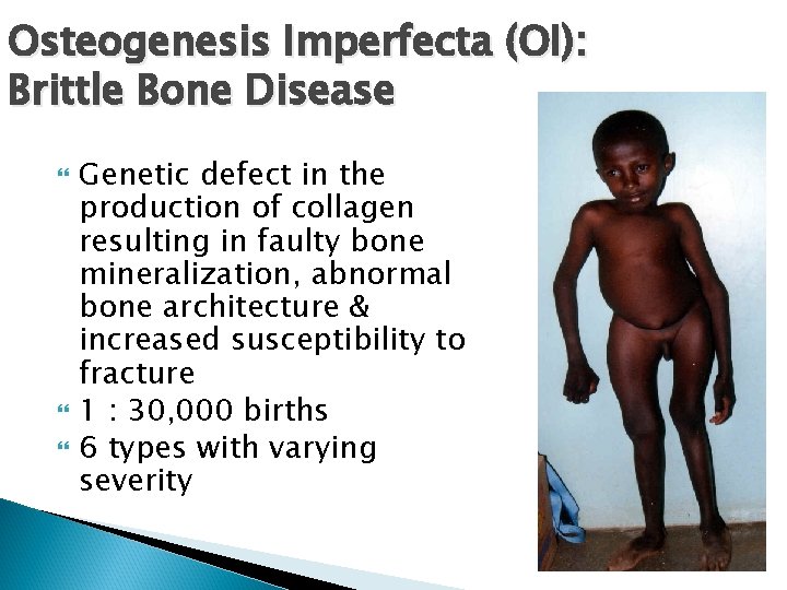 Osteogenesis Imperfecta (OI): Brittle Bone Disease Genetic defect in the production of collagen resulting