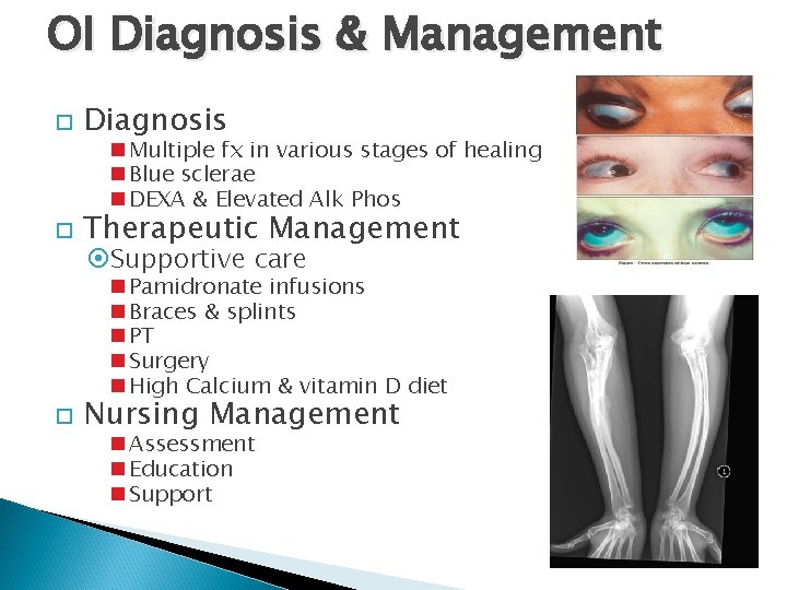 OI Diagnosis & Management Diagnosis Therapeutic Management Multiple fx in various stages of healing
