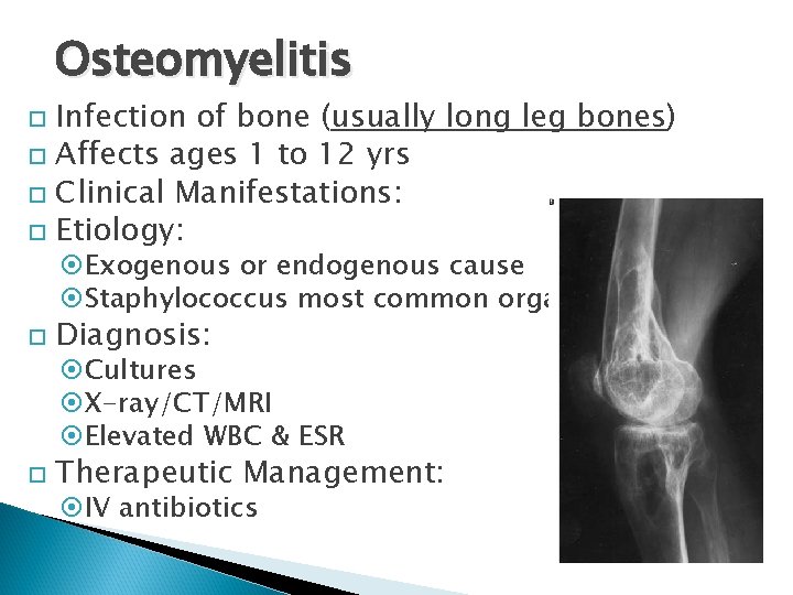 Osteomyelitis Infection of bone (usually long leg bones) Affects ages 1 to 12 yrs