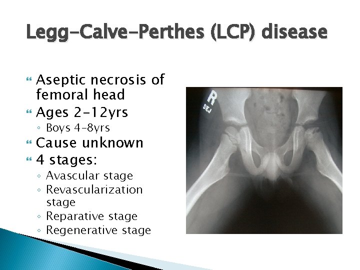 Legg-Calve-Perthes (LCP) disease Aseptic necrosis of femoral head Ages 2 -12 yrs ◦ Boys