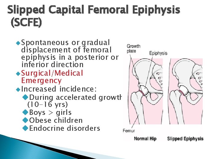 Slipped Capital Femoral Epiphysis (SCFE) Spontaneous or gradual displacement of femoral epiphysis in a
