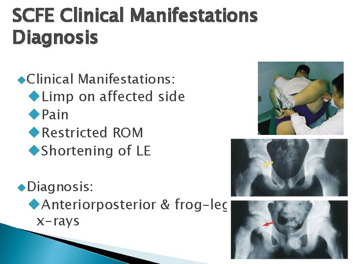 SCFE Clinical Manifestations Diagnosis Clinical Manifestations: Limp on affected side Pain Restricted ROM Shortening
