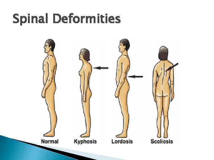 Spinal Deformities 