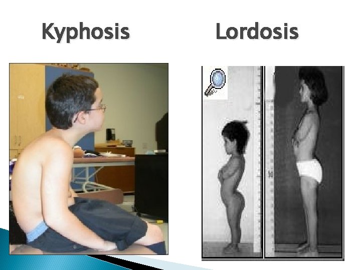 Kyphosis Lordosis 