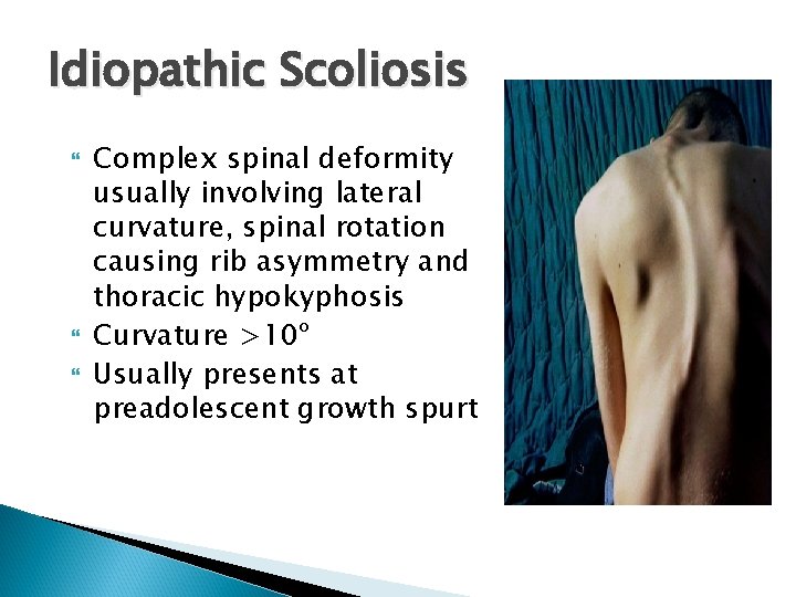 Idiopathic Scoliosis Complex spinal deformity usually involving lateral curvature, spinal rotation causing rib asymmetry