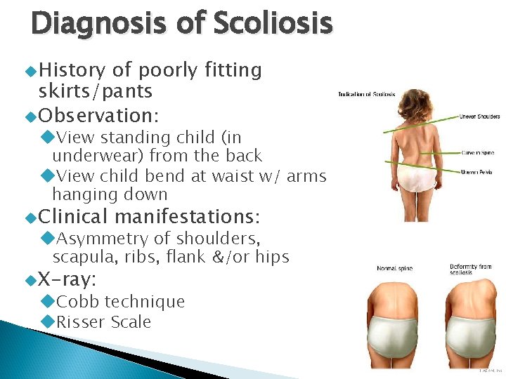 Diagnosis of Scoliosis History of poorly fitting skirts/pants Observation: View standing child (in underwear)
