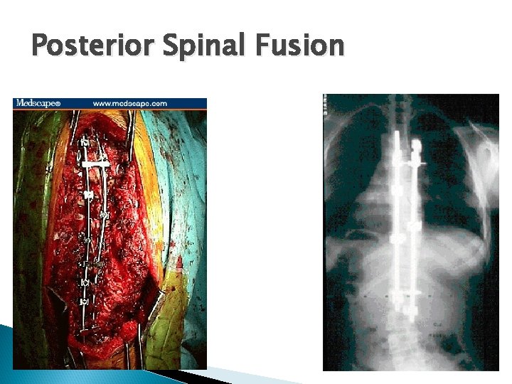 Posterior Spinal Fusion 