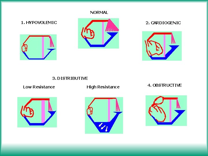 NORMAL 1. HYPOVOLEMIC 2. CARDIOGENIC 3. DISTRIBUTIVE Low Resistance High Resistance 4. OBSTRUCTIVE 