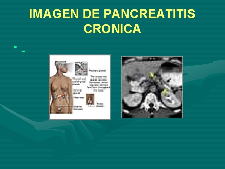 IMAGEN DE PANCREATITIS CRONICA • 