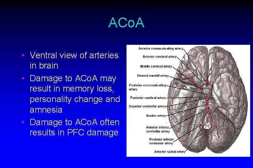 ACo. A • Ventral view of arteries in brain • Damage to ACo. A