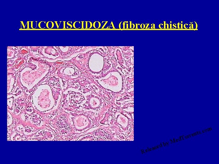 MUCOVISCIDOZA (fibroza chistică) y M b d ase e l e R ed om