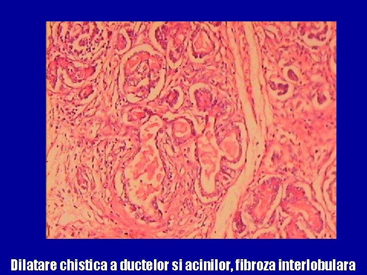 Fibroza chistică – 38 mutații CFTR