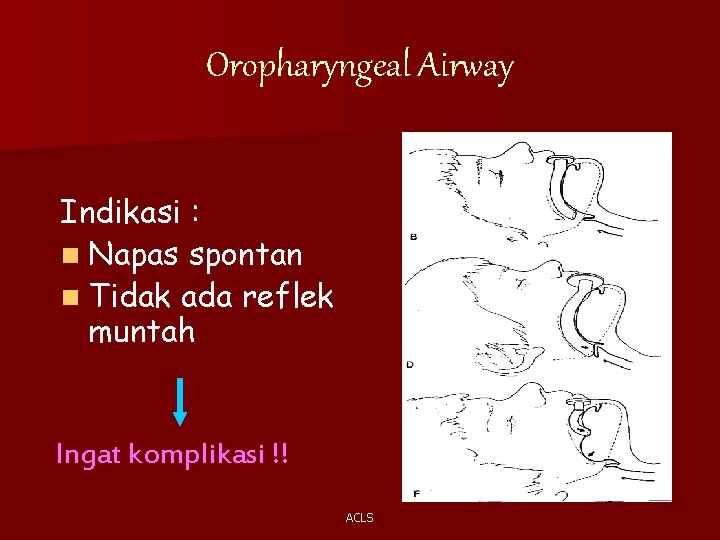 Oropharyngeal Airway Indikasi : n Napas spontan n Tidak ada reflek muntah Ingat komplikasi