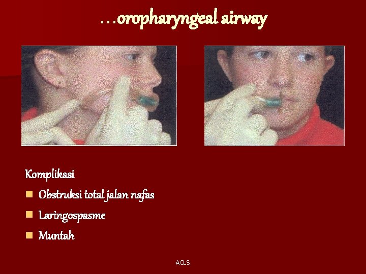 …oropharyngeal airway Komplikasi n Obstruksi total jalan nafas n Laringospasme n Muntah ACLS 