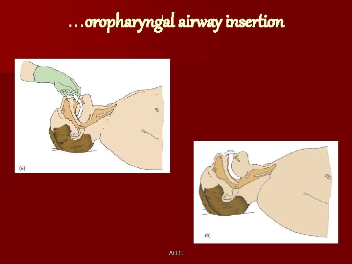 …oropharyngal airway insertion ACLS 